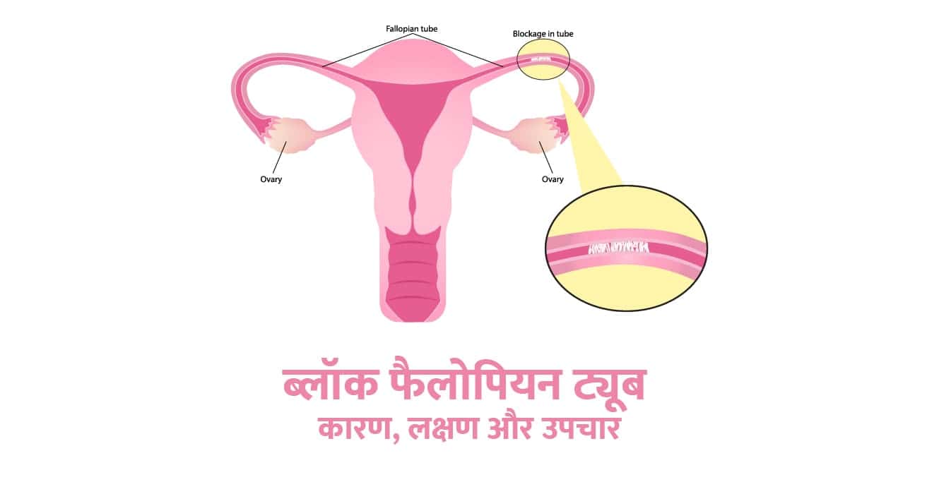 Fallopian Tube in Hindi &#8211; ब्लॉक फैलोपियन ट्यूब के कारण, लक्षण और उपचार