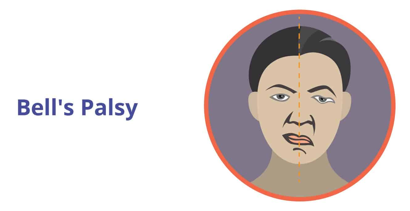 Bell’s Palsy: Causes, Symptoms, Diagnosis and Treatment