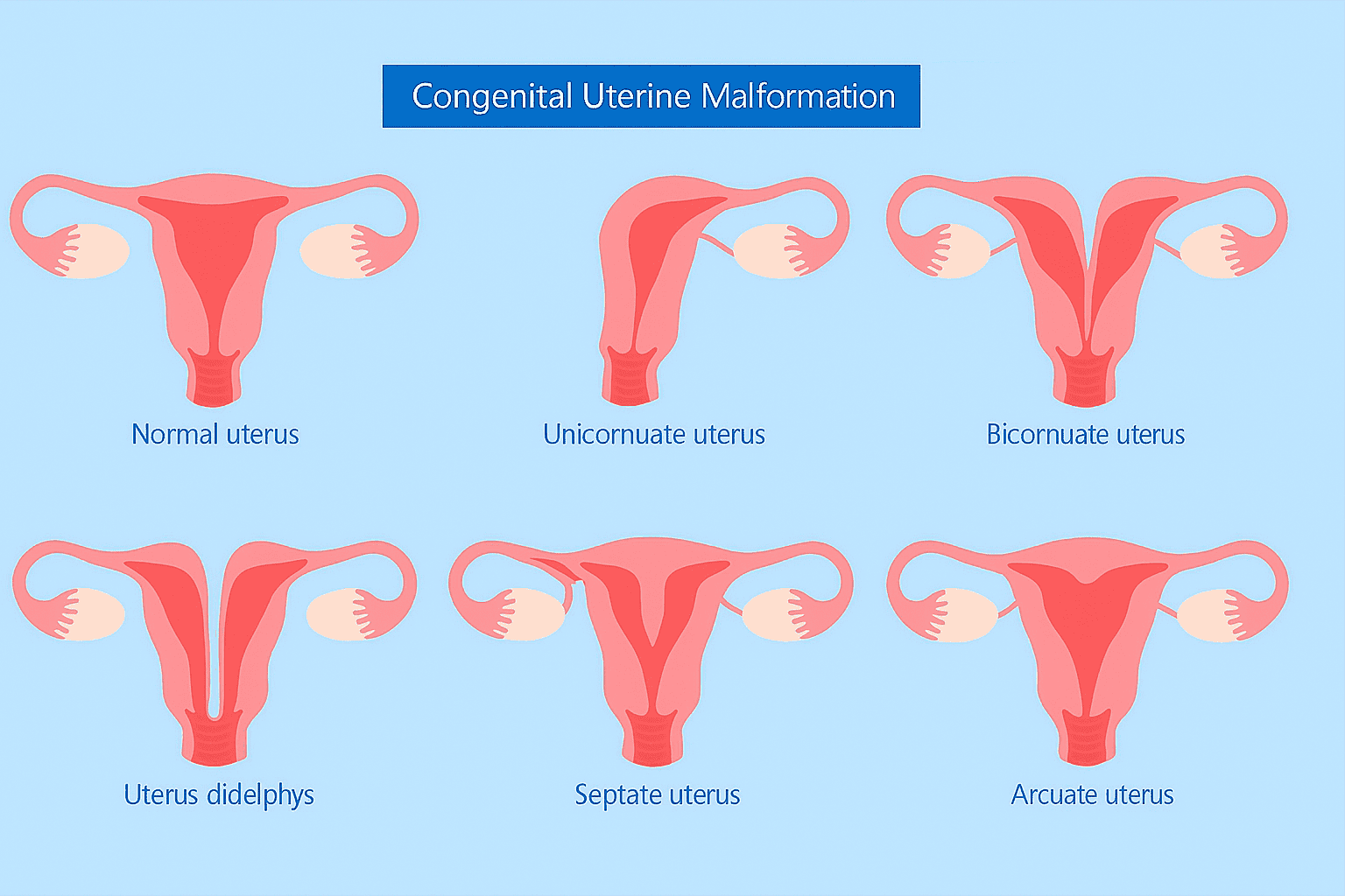 Medical infographic titled 'Congenital Uterine Malformation' showing six types of uterus shapes: normal uterus, unicornuate uterus, bicornuate uterus, uterus didelphys, septate uterus, and arcuate uterus, with clear anatomical illustrations on a blue background.