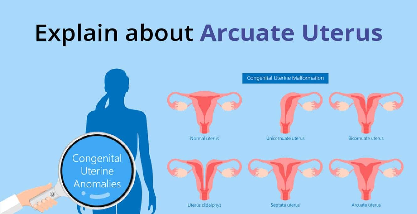 Arcuate Uterus কি? কারণ, লক্ষণ ও চিকিৎসা