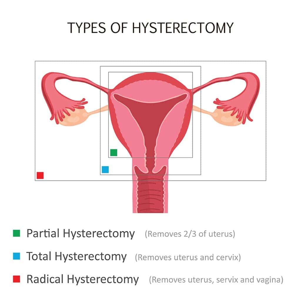 Medical diagram showing types of hysterectomy with an illustration of the female reproductive system. Green indicates partial hysterectomy (removes two-thirds of the uterus), blue indicates total hysterectomy (removes uterus and cervix), and red indicates radical hysterectomy (removes uterus, cervix, and vagina).
