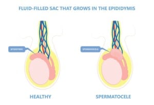 spermatocele-symptoms-causes-and-treatments