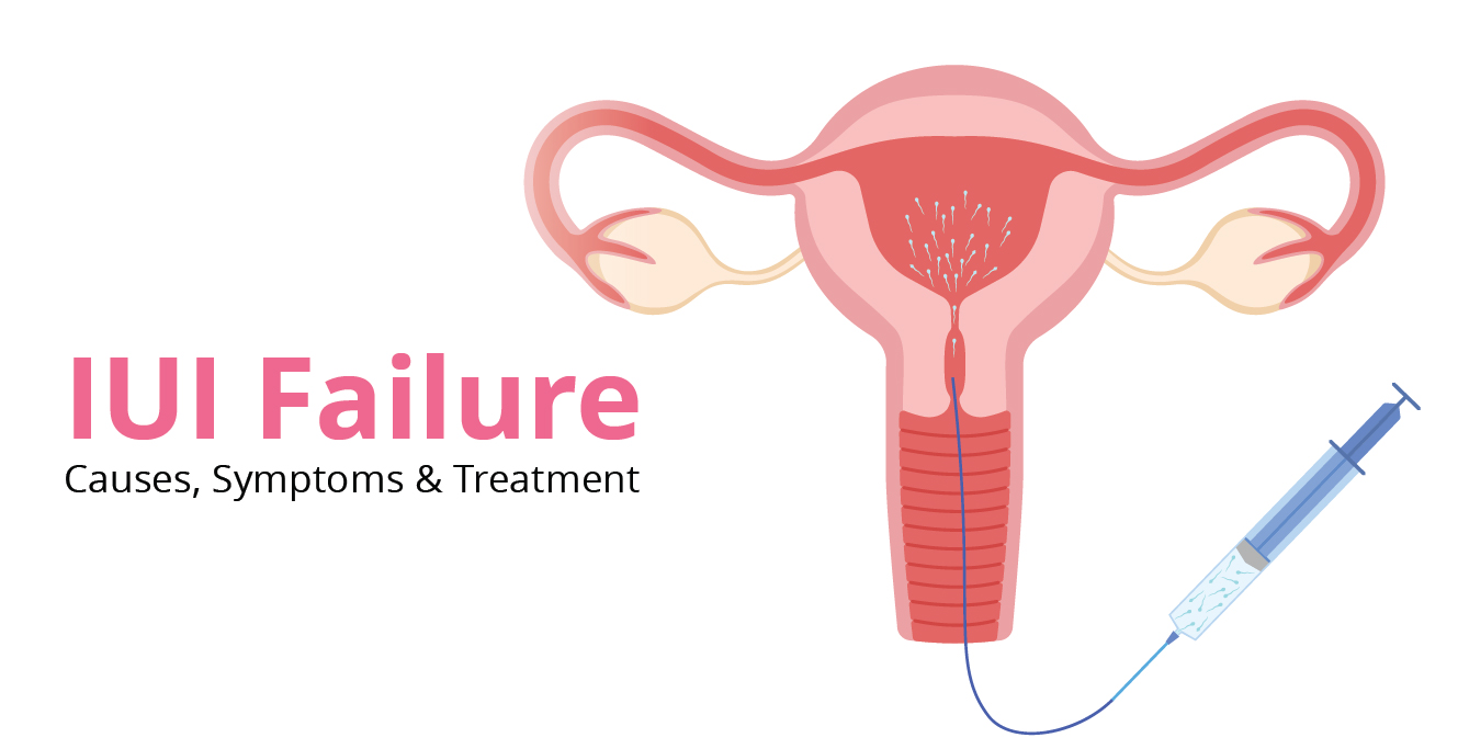 IUI failure: Causes, Symptoms & Treatment